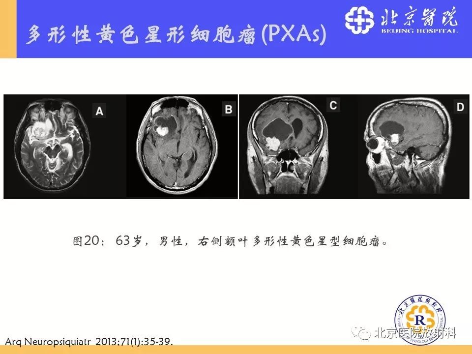 【PPT】多结节和空泡状神经元肿瘤