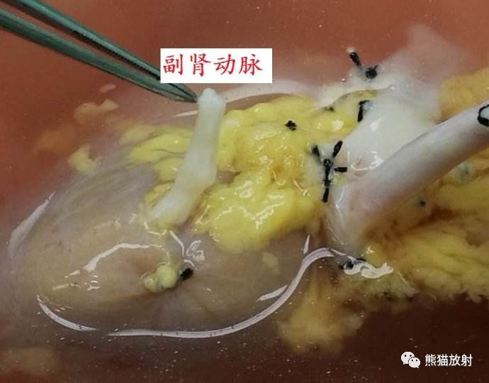 副肾动脉 副肾动脉