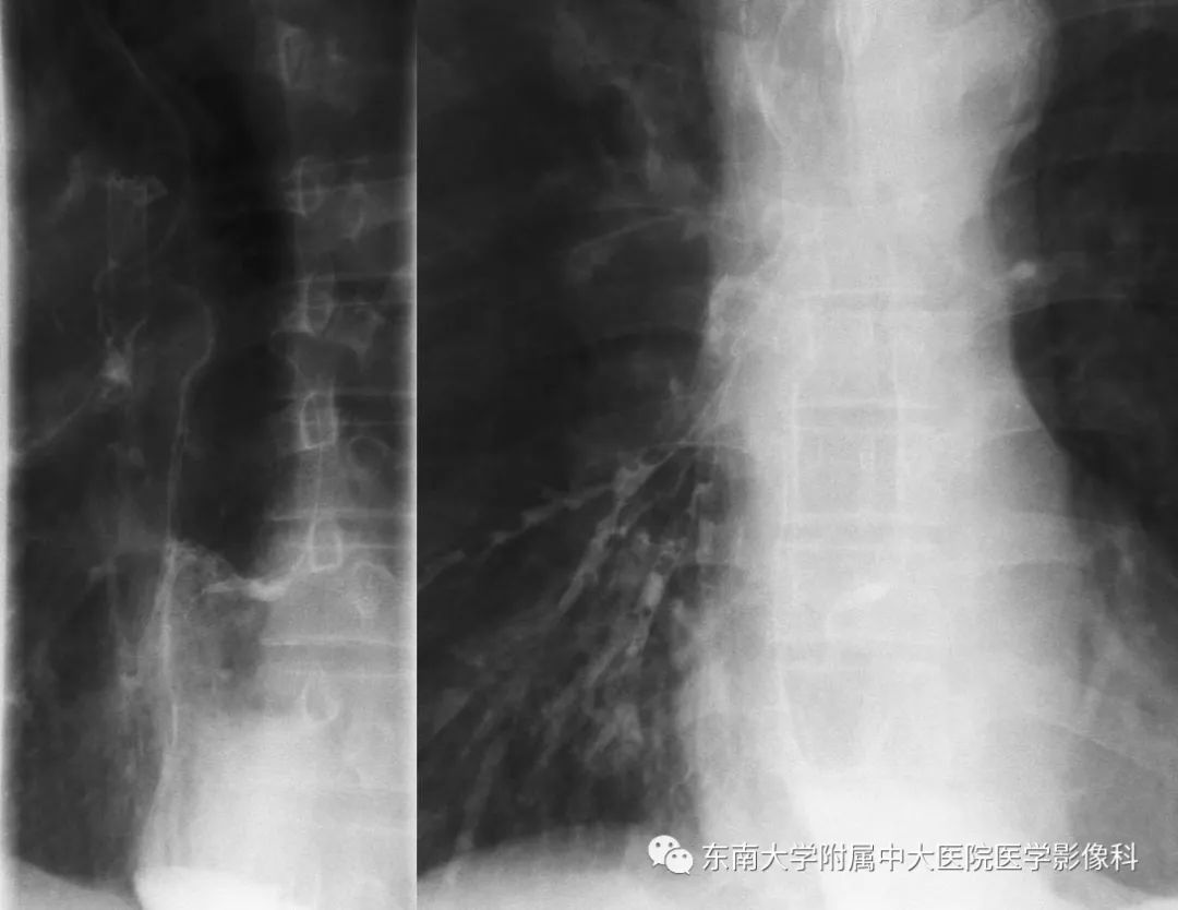 【PPT】食管癌并发食管瘘及其影像学表现