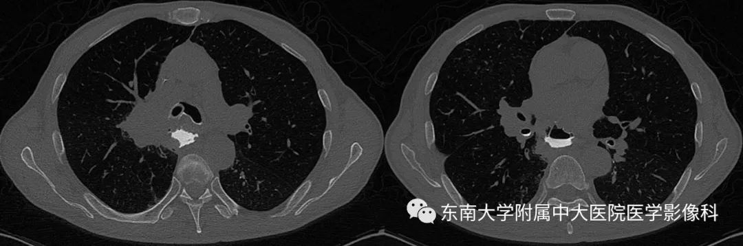 【PPT】食管癌并发食管瘘及其影像学表现