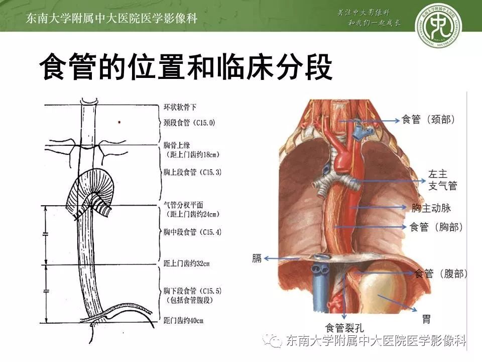 【PPT】食管癌并发食管瘘及其影像学表现