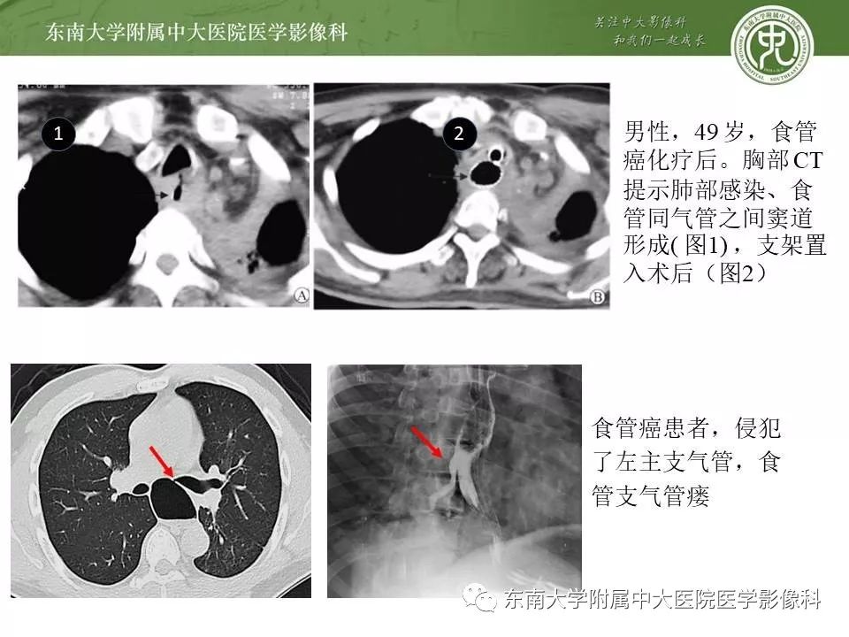 【PPT】食管癌并发食管瘘及其影像学表现