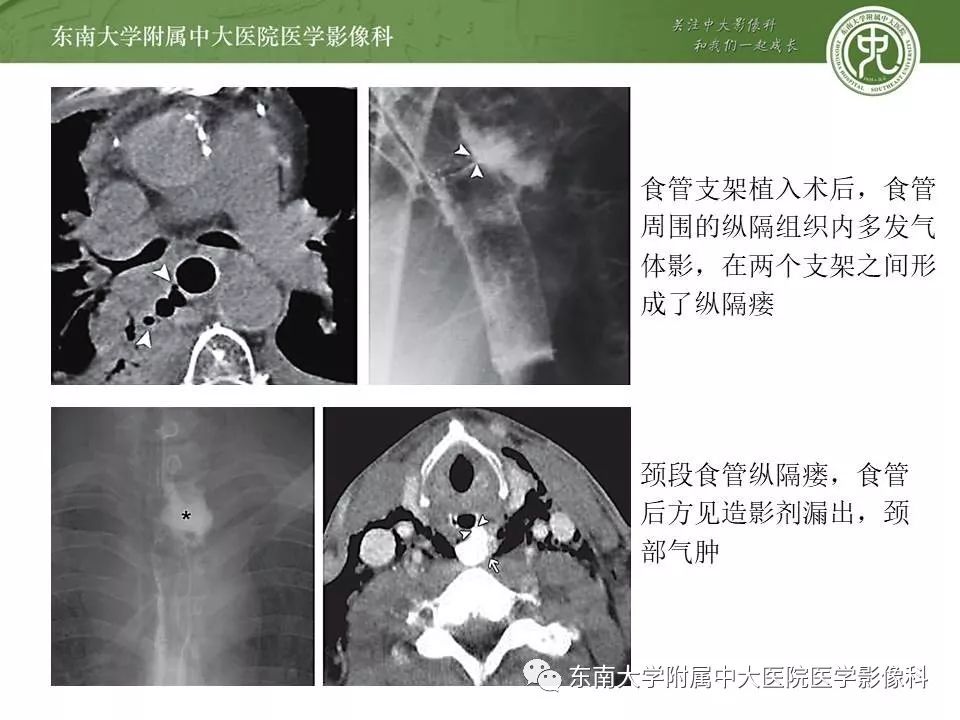 【PPT】食管癌并发食管瘘及其影像学表现