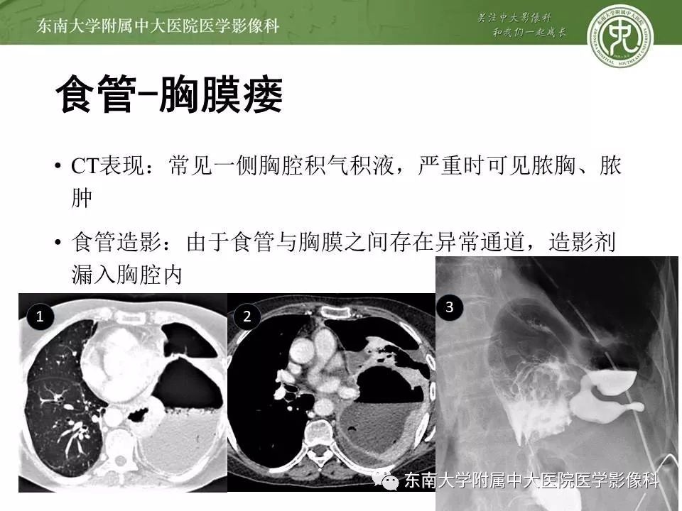 【PPT】食管癌并发食管瘘及其影像学表现