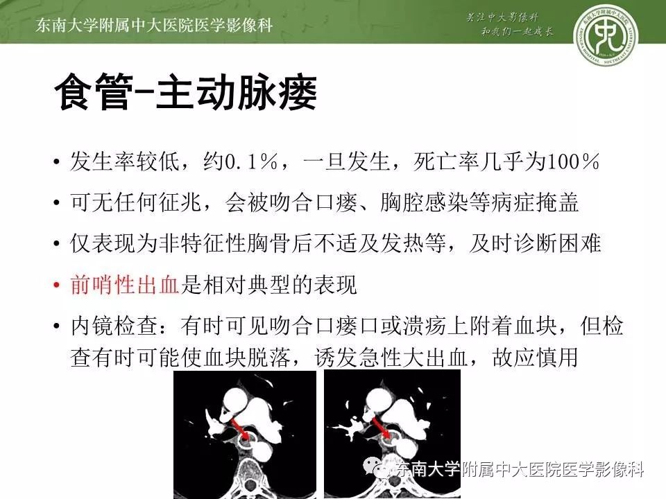 【PPT】食管癌并发食管瘘及其影像学表现
