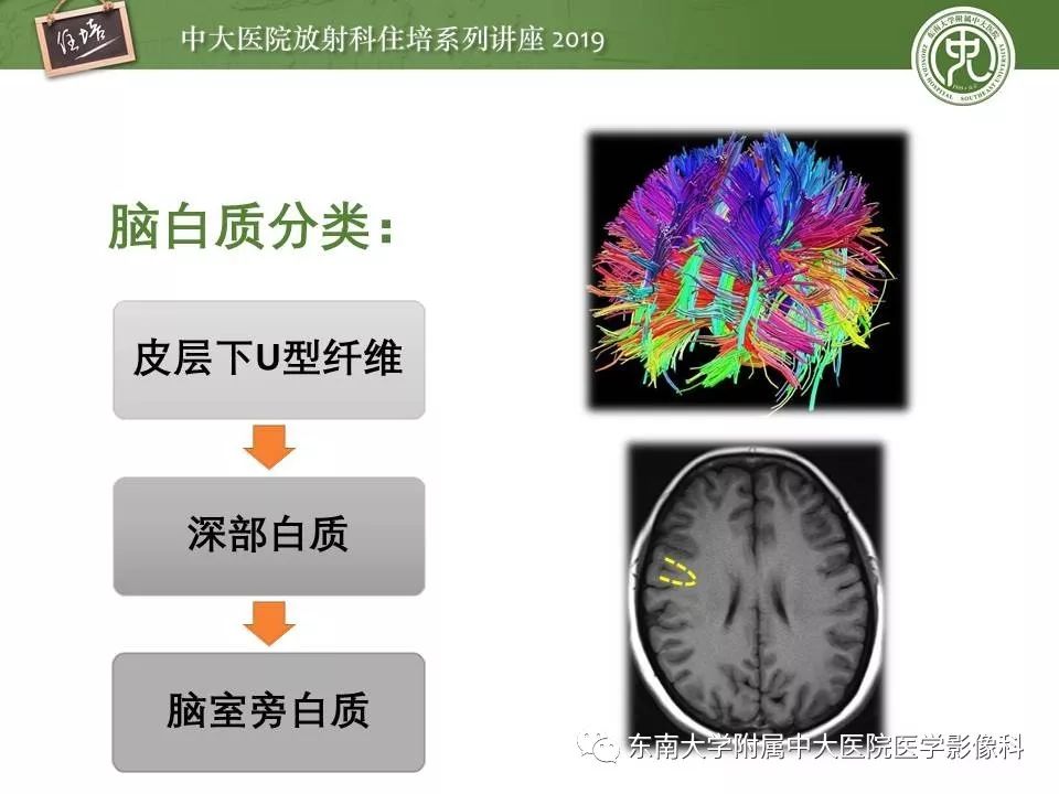 【PPT】多发性硬化的影像表现及鉴别诊断