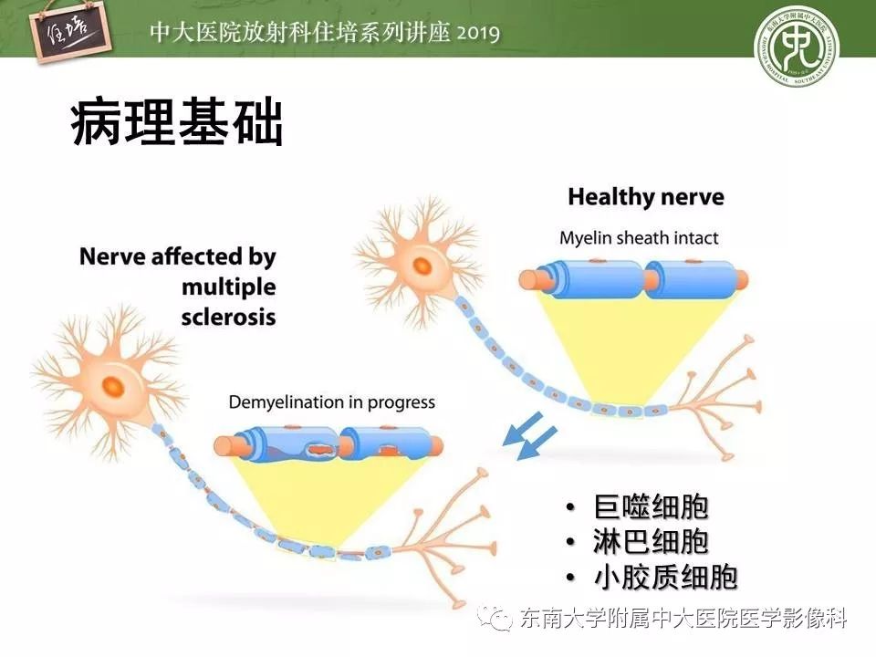 【PPT】多发性硬化的影像表现及鉴别诊断