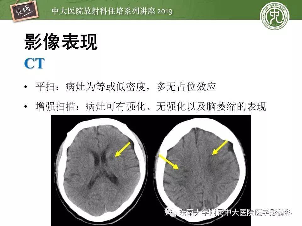 【PPT】多发性硬化的影像表现及鉴别诊断