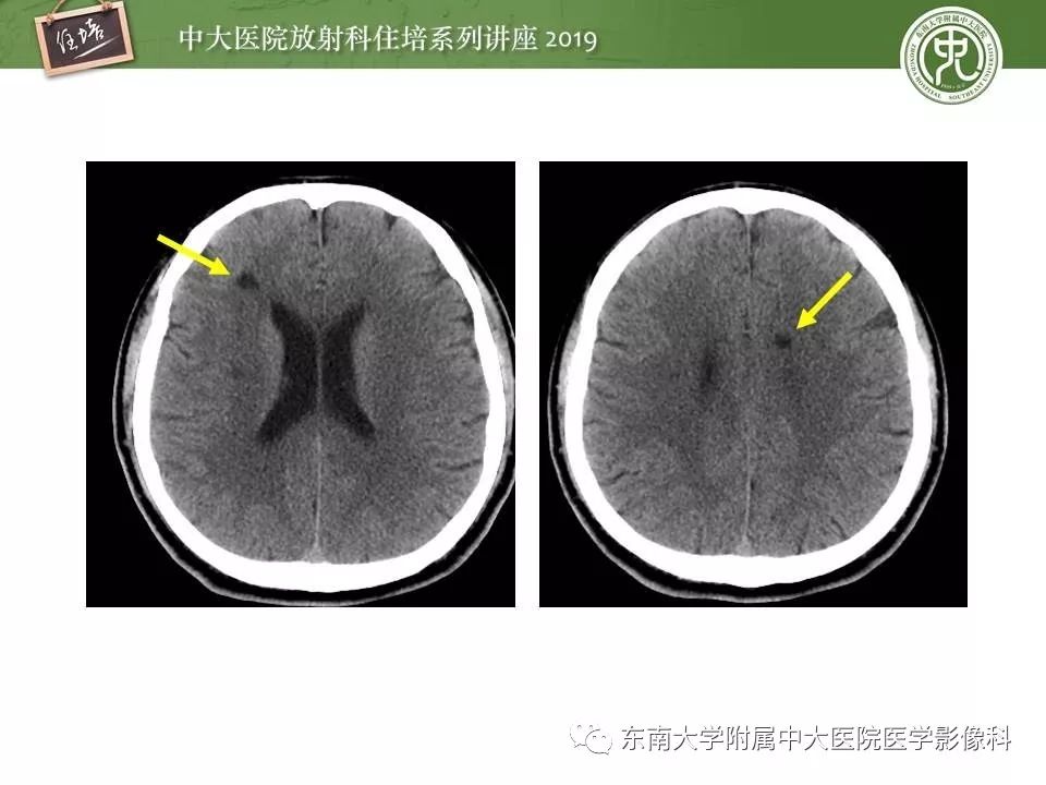 【PPT】多发性硬化的影像表现及鉴别诊断