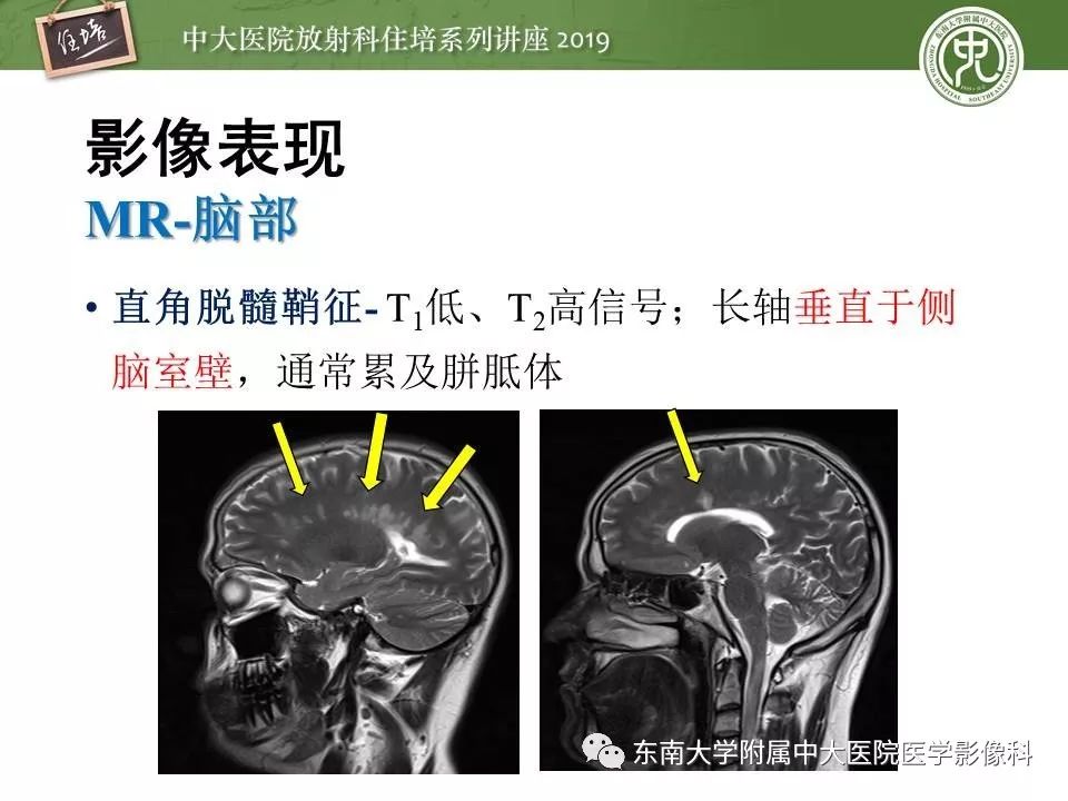 【PPT】多发性硬化的影像表现及鉴别诊断