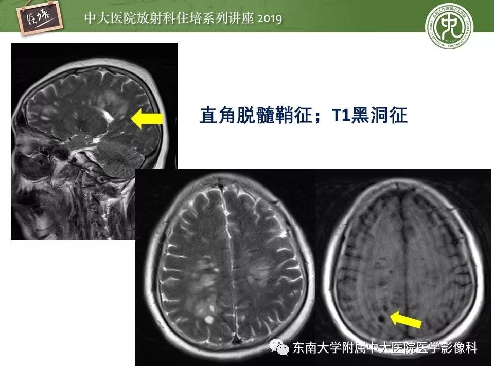 【PPT】多发性硬化的影像表现及鉴别诊断