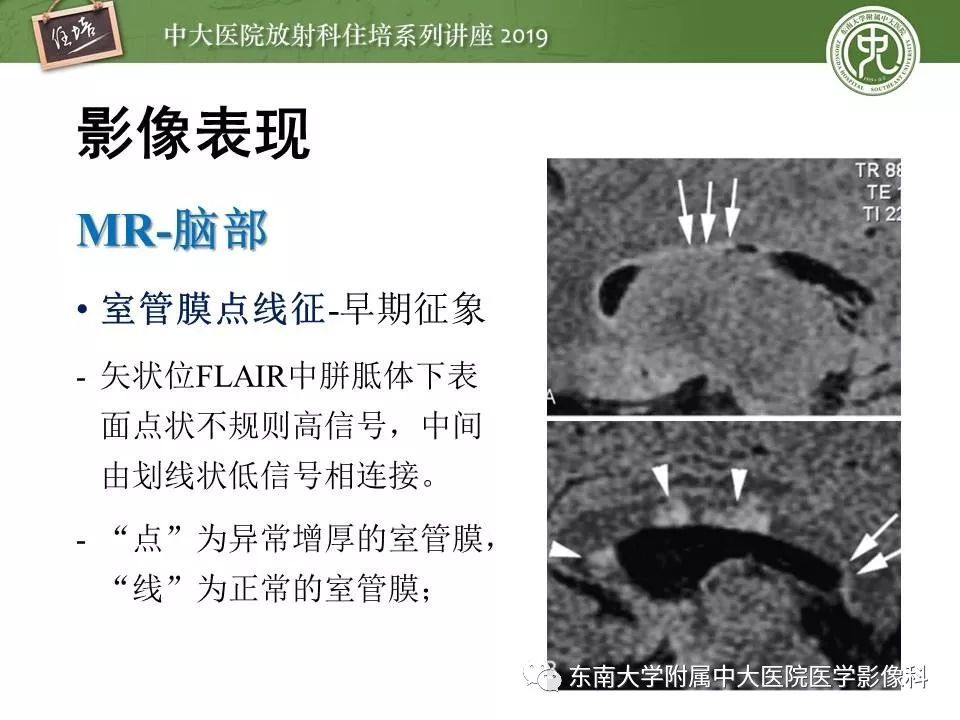 【PPT】多发性硬化的影像表现及鉴别诊断