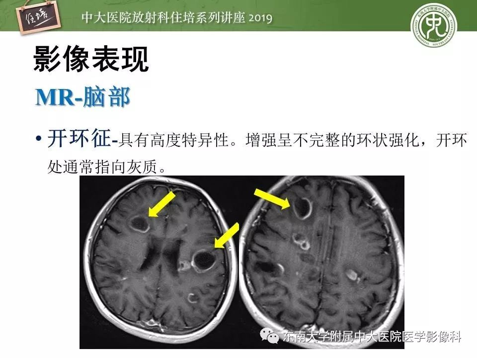 【PPT】多发性硬化的影像表现及鉴别诊断