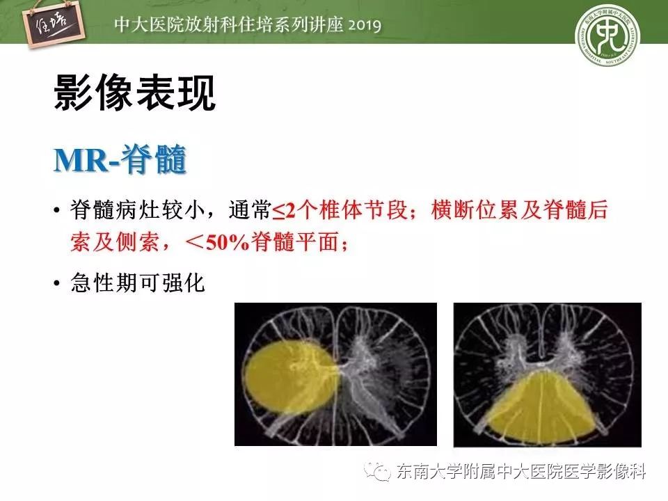 【PPT】多发性硬化的影像表现及鉴别诊断