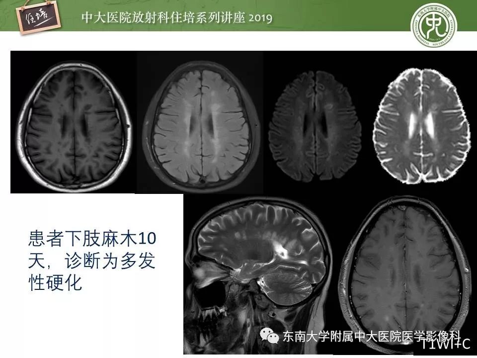 【PPT】多发性硬化的影像表现及鉴别诊断