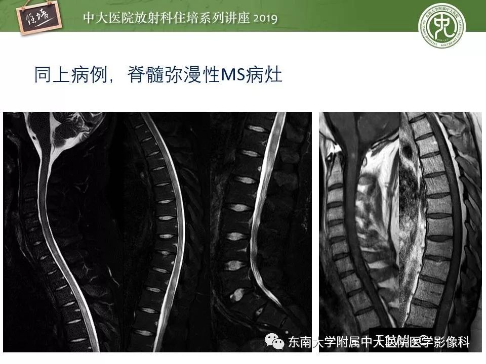 【PPT】多发性硬化的影像表现及鉴别诊断
