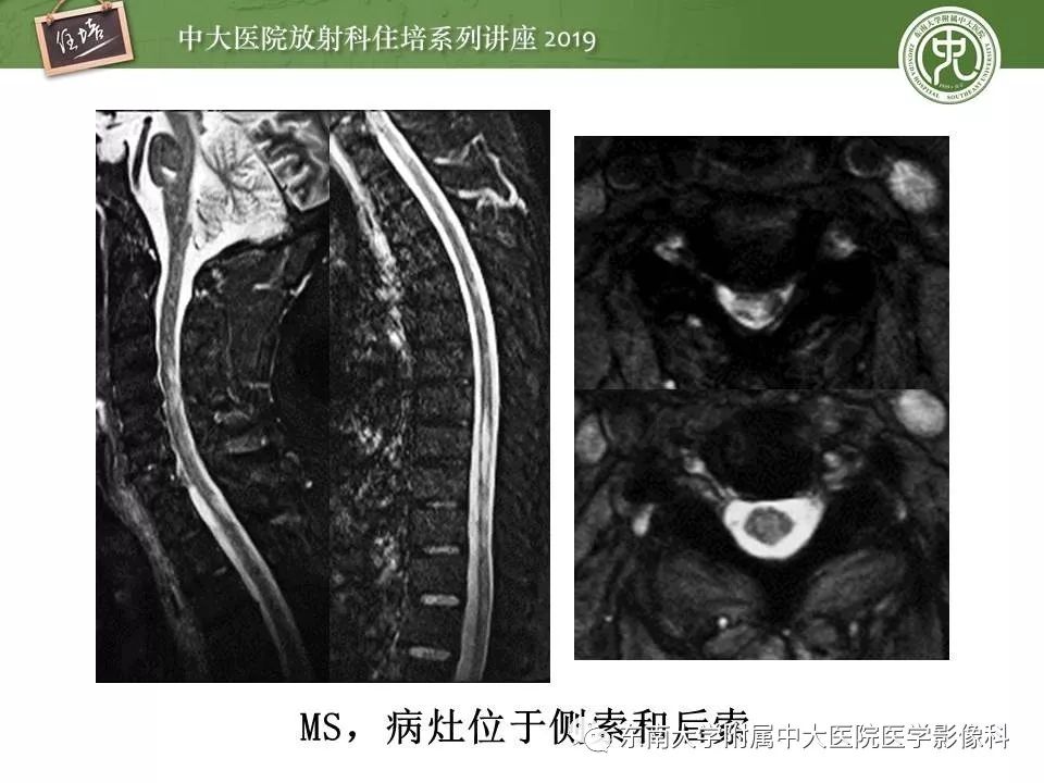 【PPT】多发性硬化的影像表现及鉴别诊断