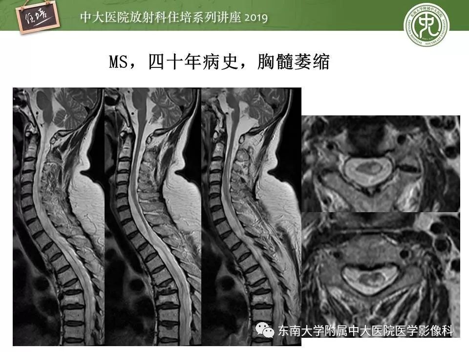 【PPT】多发性硬化的影像表现及鉴别诊断