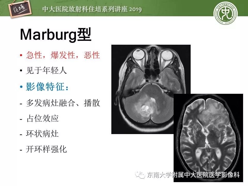 【PPT】多发性硬化的影像表现及鉴别诊断