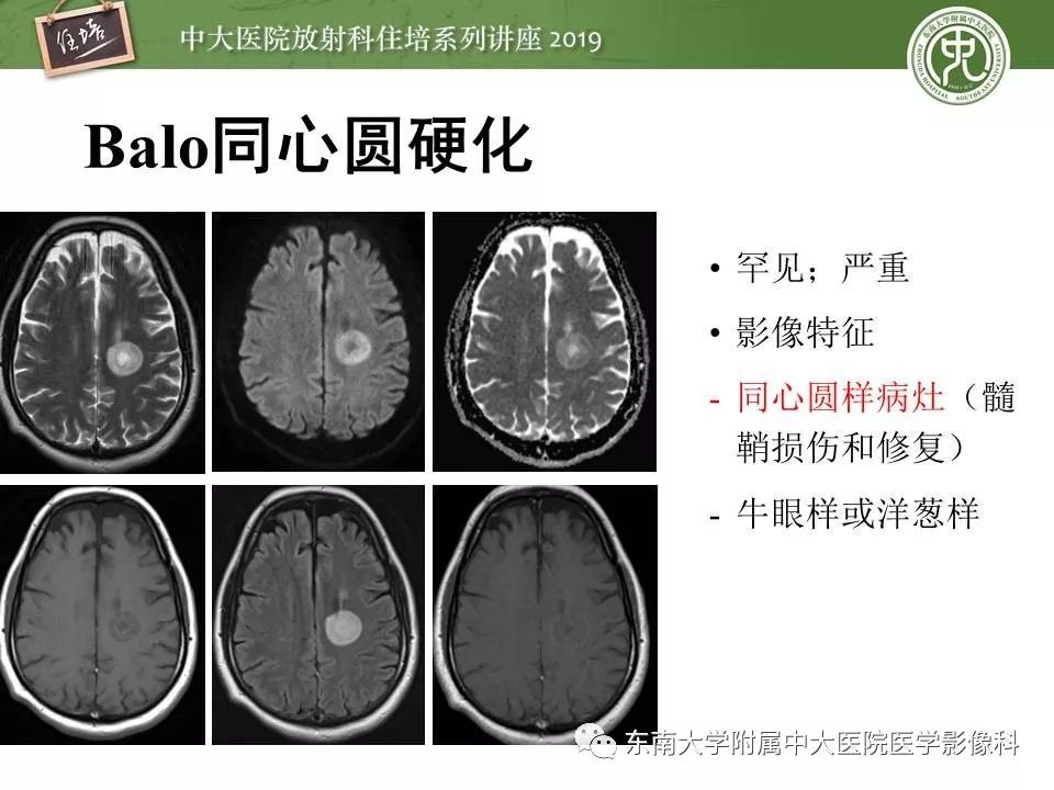【PPT】多发性硬化的影像表现及鉴别诊断