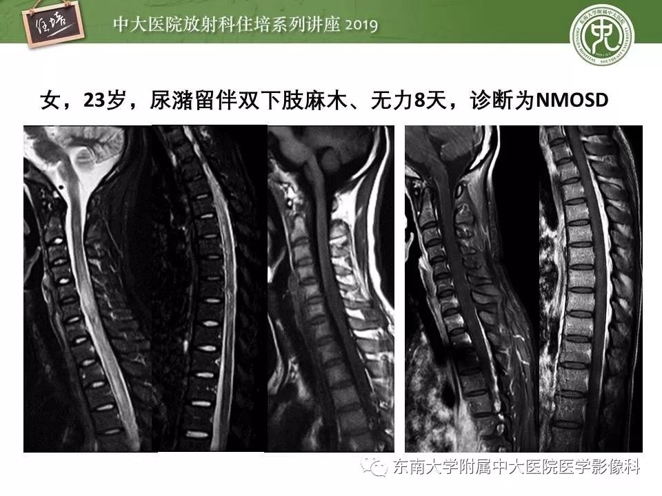 【PPT】多发性硬化的影像表现及鉴别诊断