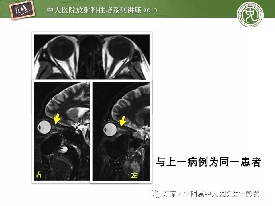 【PPT】多发性硬化的影像表现及鉴别诊断