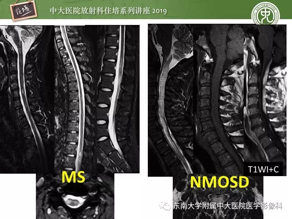 【PPT】多发性硬化的影像表现及鉴别诊断