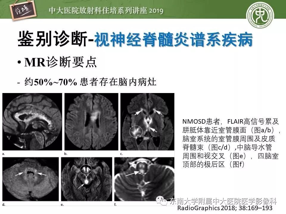 【PPT】多发性硬化的影像表现及鉴别诊断