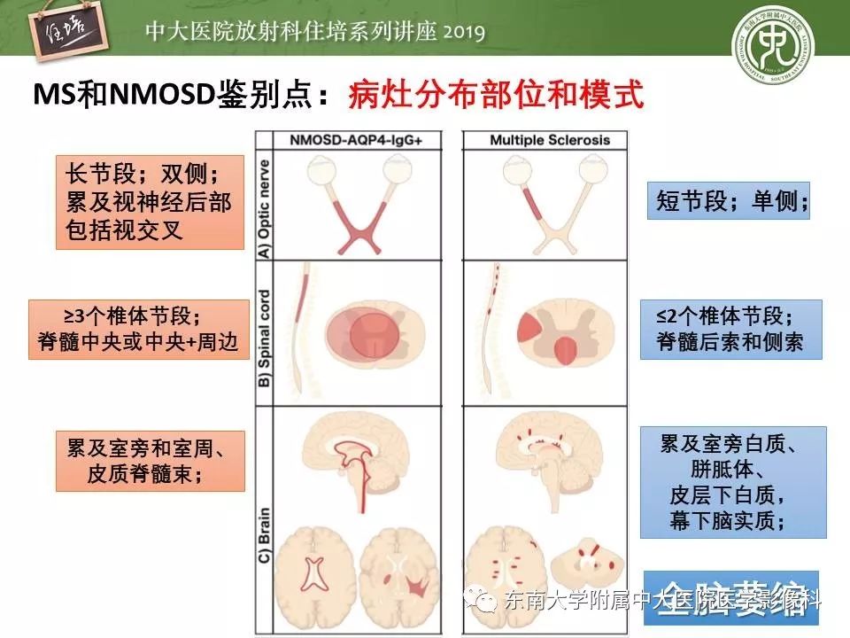 【PPT】多发性硬化的影像表现及鉴别诊断