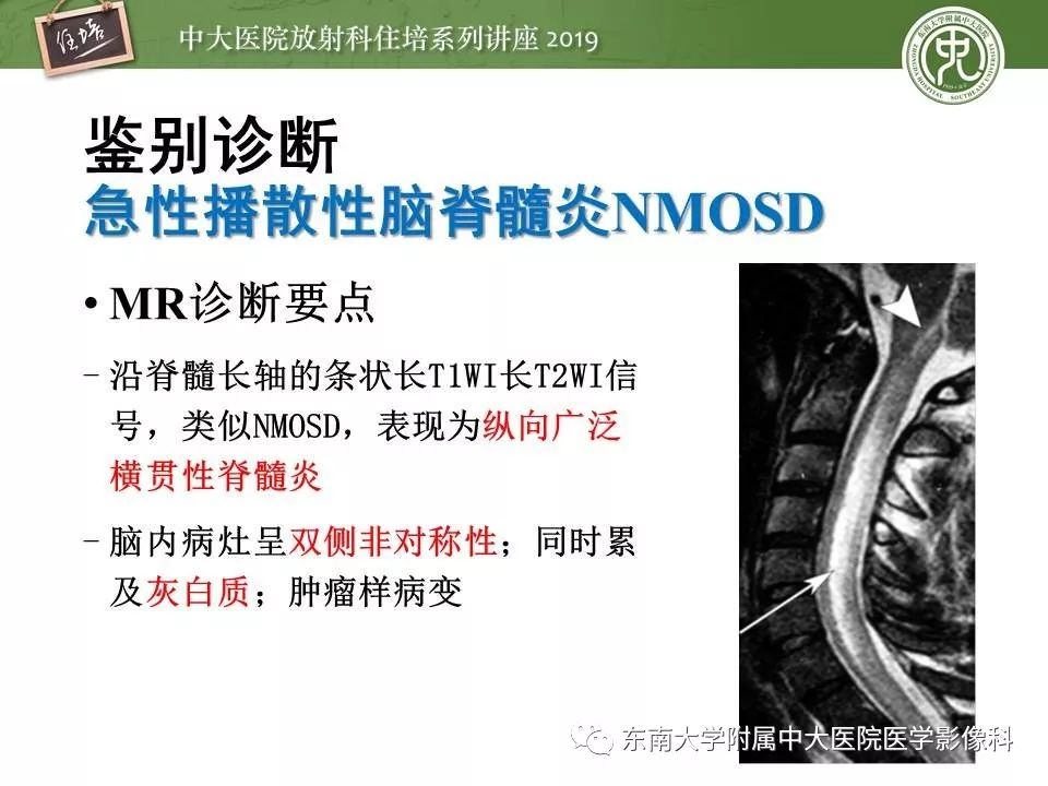 【PPT】多发性硬化的影像表现及鉴别诊断