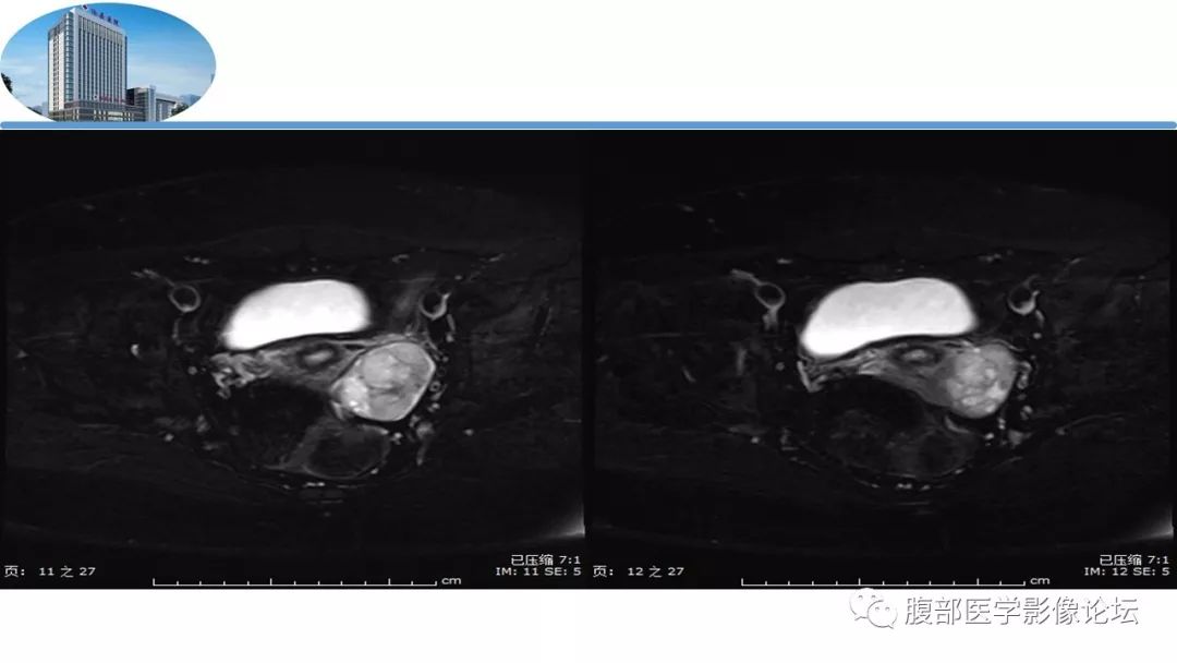 【病例】卵巢硬化性间质瘤1例MR影像诊断