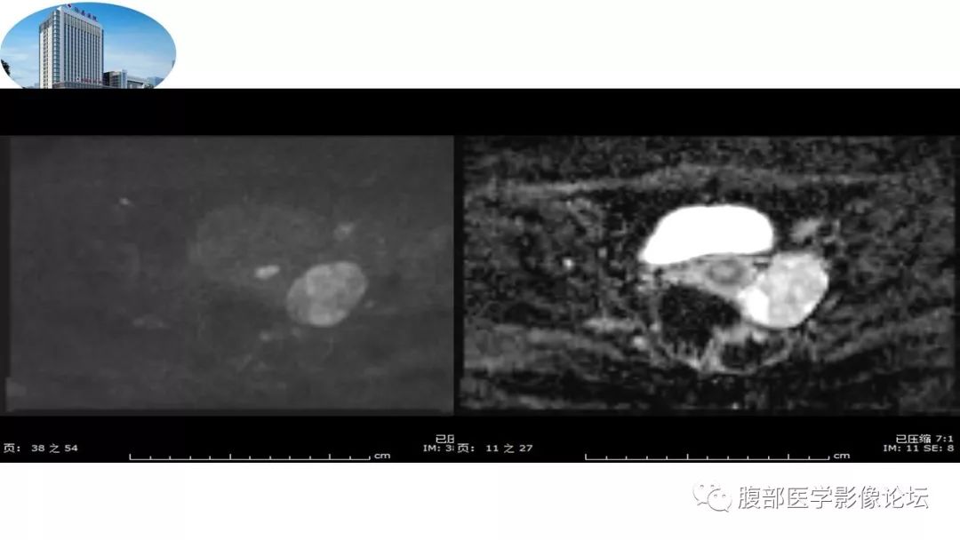 【病例】卵巢硬化性间质瘤1例MR影像诊断