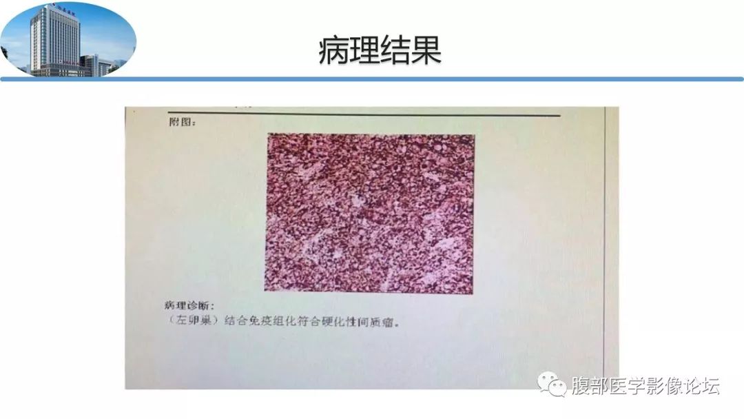 【病例】卵巢硬化性间质瘤1例MR影像诊断