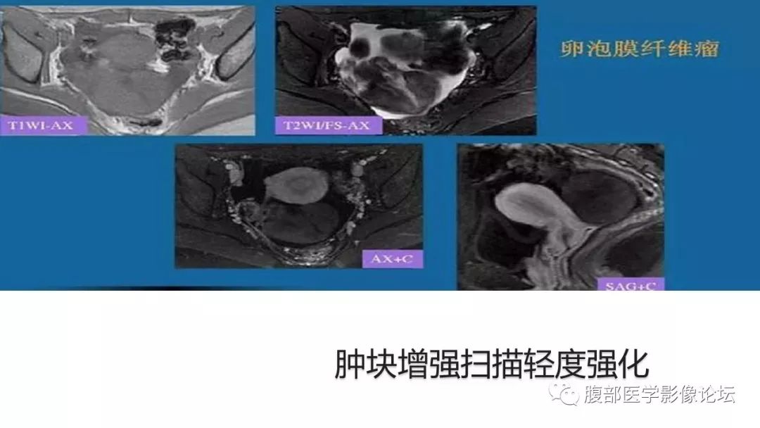 【病例】卵巢硬化性间质瘤1例MR影像诊断