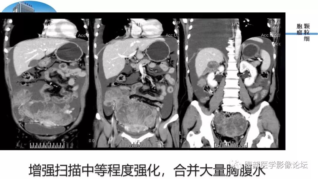 【病例】卵巢硬化性间质瘤1例MR影像诊断