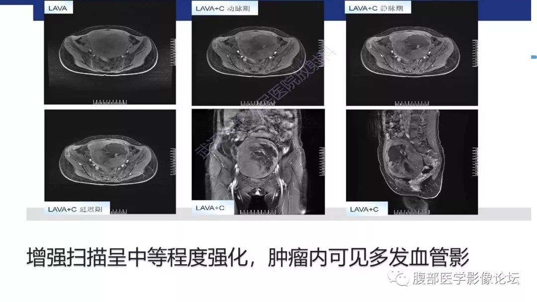 【病例】卵巢硬化性间质瘤1例MR影像诊断