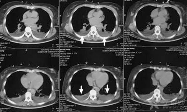 影像入门必备:6 种最常见的胸部 CT 征象 影像入门必备:6 种最常见的胸部 CT 征象