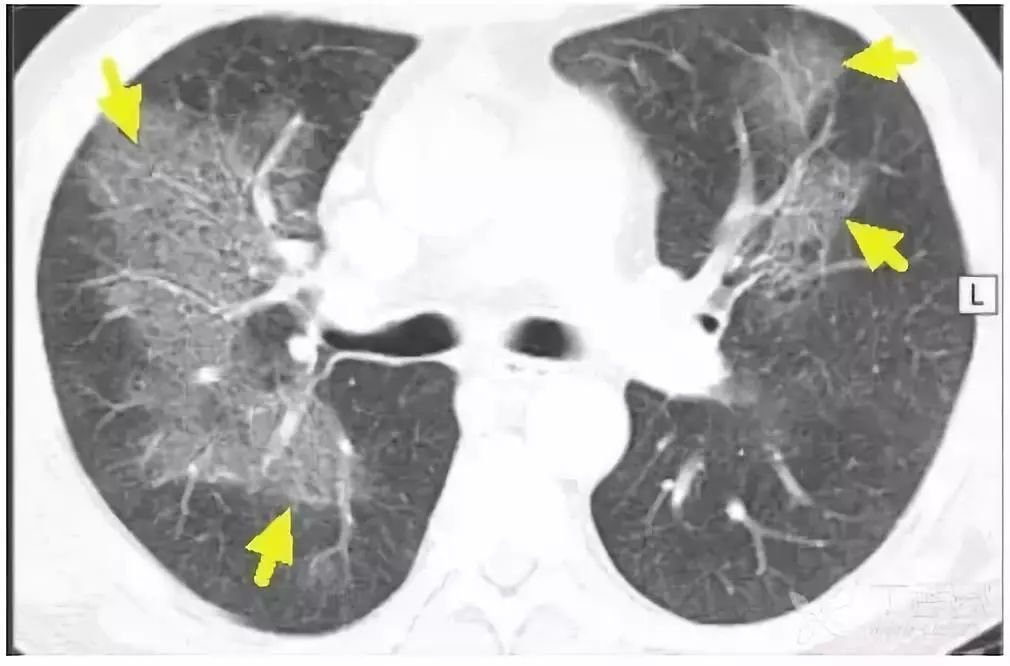 影像入门必备：6 种最常见的胸部 CT 征象