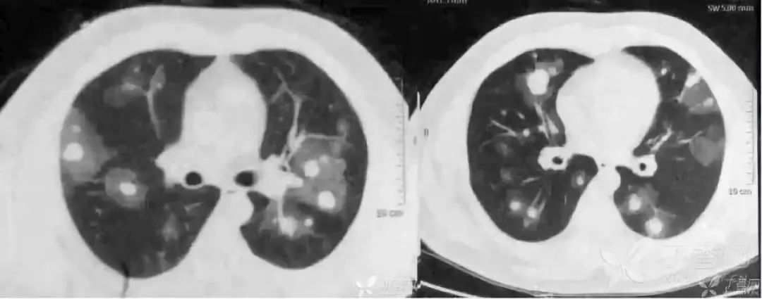 影像入门必备:6 种最常见的胸部 CT 征象 影像入门必备:6 种最常见的胸部 CT 征象