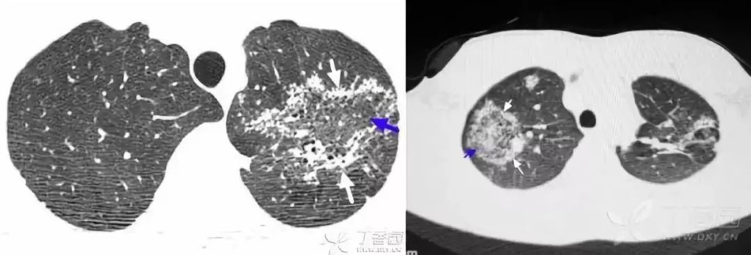 影像入门必备:6 种最常见的胸部 CT 征象 影像入门必备:6 种最常见的胸部 CT 征象