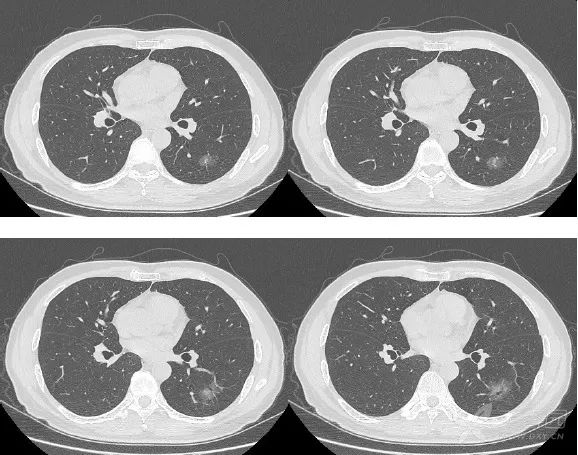 影像入门必备:6 种最常见的胸部 CT 征象 影像入门必备:6 种最常见的胸部 CT 征象