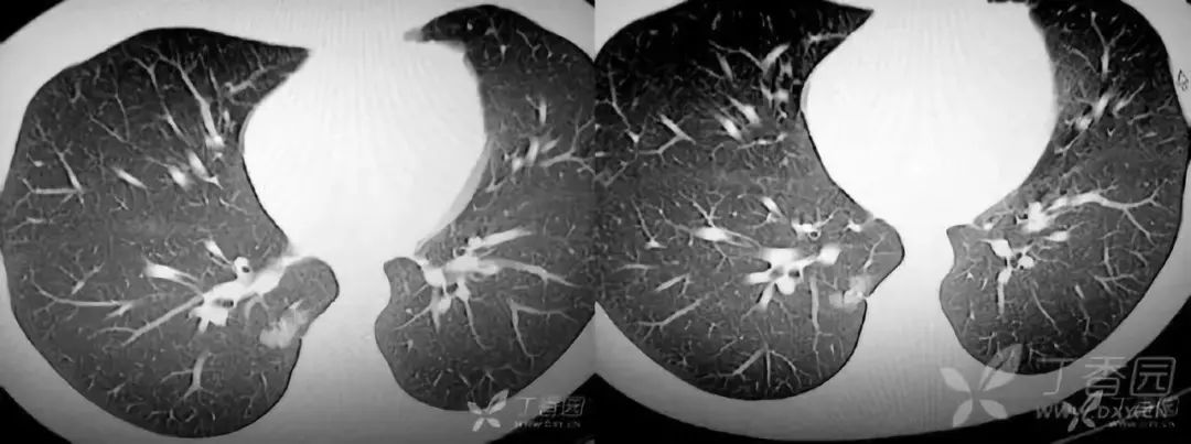 影像入门必备:6 种最常见的胸部 CT 征象 影像入门必备:6 种最常见的胸部 CT 征象