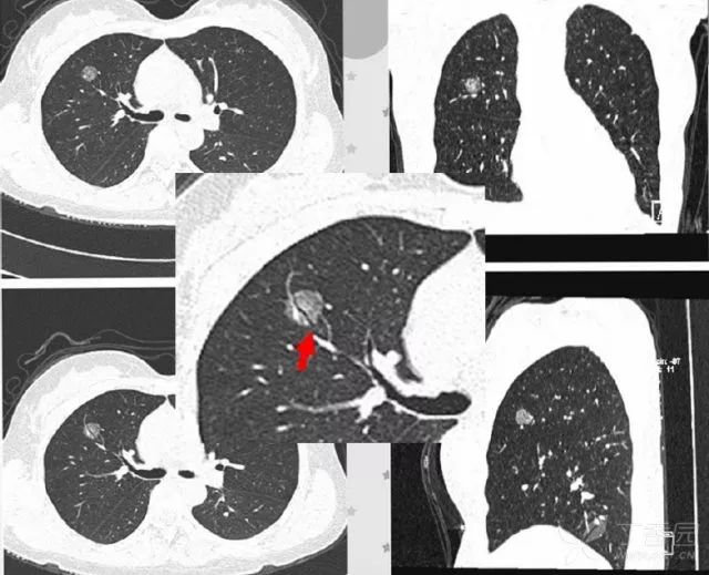 影像入门必备:6 种最常见的胸部 CT 征象 影像入门必备:6 种最常见的胸部 CT 征象
