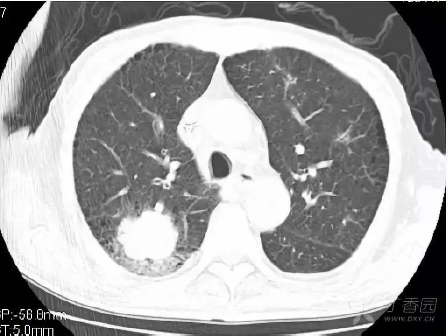 影像入门必备:6 种最常见的胸部 CT 征象 影像入门必备:6 种最常见的胸部 CT 征象