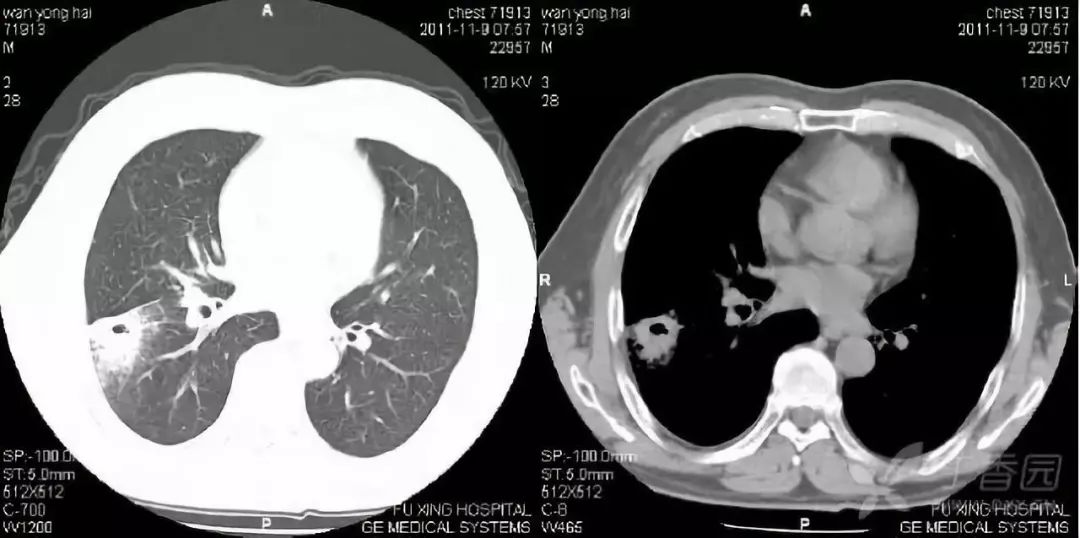 影像入门必备:6 种最常见的胸部 CT 征象 影像入门必备:6 种最常见的胸部 CT 征象