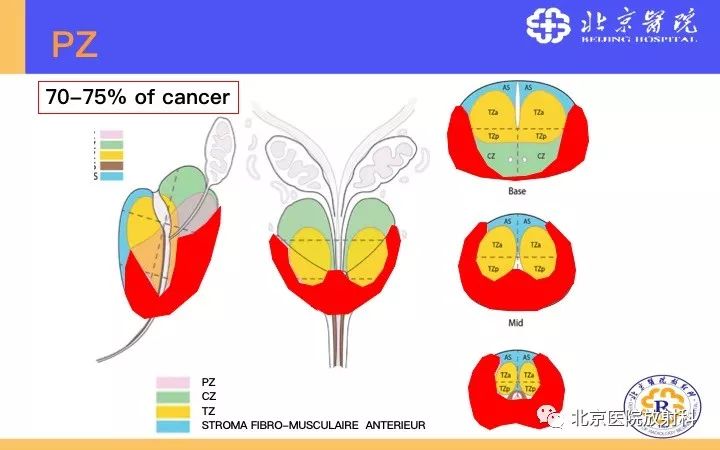 【PPT】男性盆腔常见疾病MR诊断