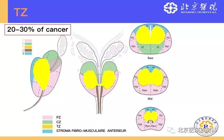 【PPT】男性盆腔常见疾病MR诊断