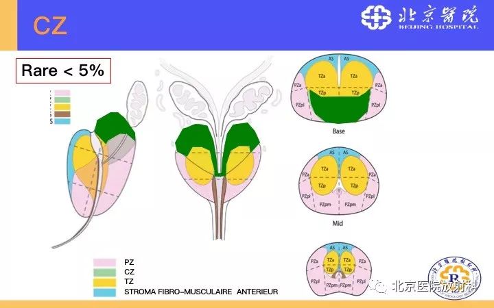【PPT】男性盆腔常见疾病MR诊断