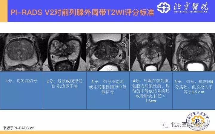 【PPT】男性盆腔常见疾病MR诊断
