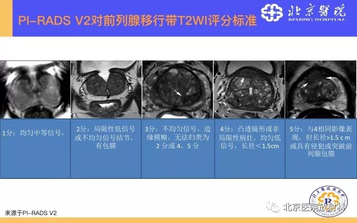 【PPT】男性盆腔常见疾病MR诊断